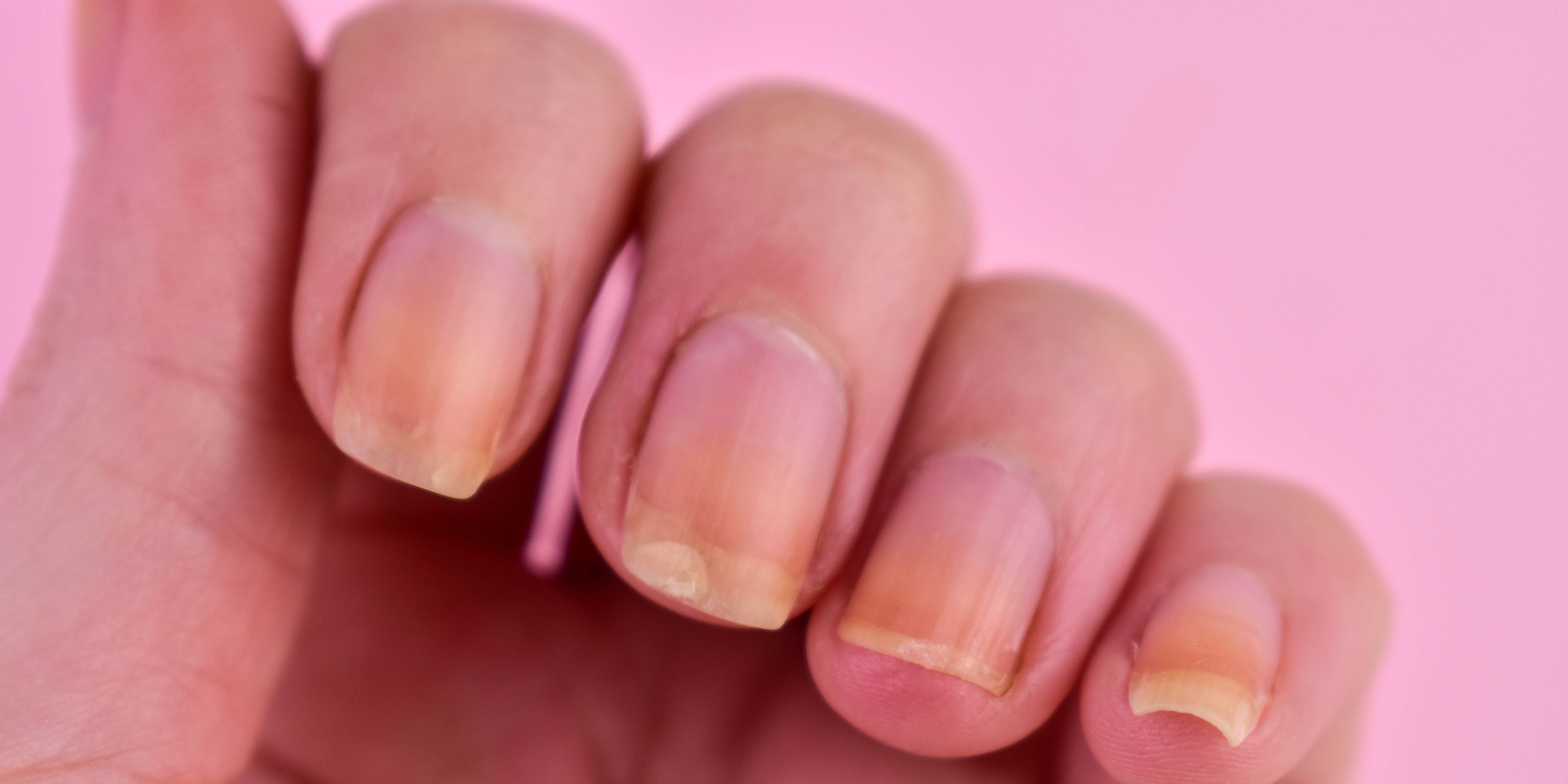 Yellow Nails: Causes, Health Conditions, and How to Treat Them